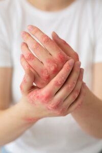 Tratamento para Alergias Cutâneas: Dermatite Atópica e UrticáriaMétodos para aliviar sintomas e controlar reações de pele.