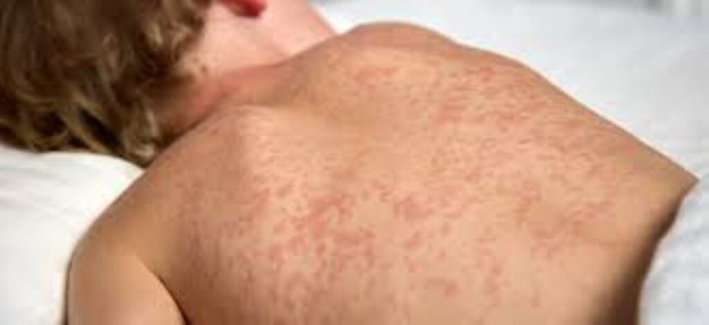 Casos de sarampo voltam a aparecer: saiba como se proteger! 1 Erupção cutânea visível nas costas de uma pessoa com manchas vermelhas espalhadas