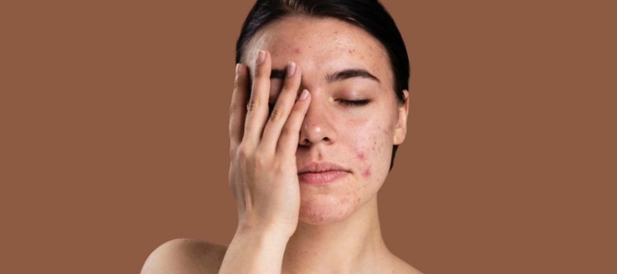 Imagem de uma mulher com acne e rosácea, ilustrando as condições de pele tratadas com Ácido Zella. 