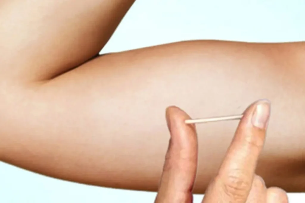 Implanon. Imagem uma pessoa mostrando um implante contraceptivo no braço.