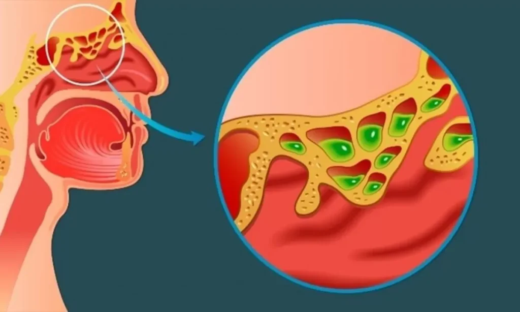 Imagem mostrando a inflamação nas vias nasais devido à rinite alérgica, com acúmulo de secreção nas cavidades nasais.